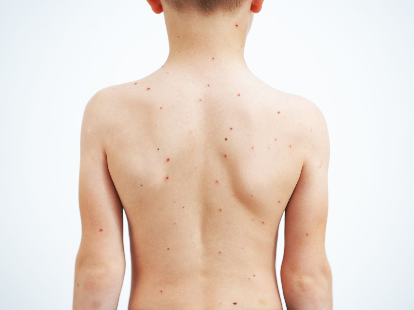 Vodene kozice na malenom dječaku Herpes zoster u obliku vodenih kozica na malenom dječaku