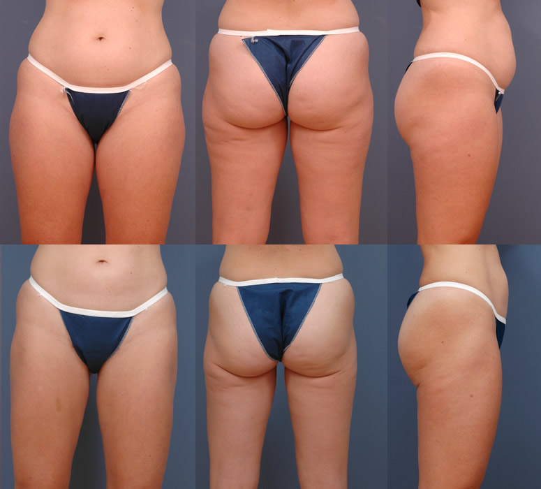 Tummy Tuck