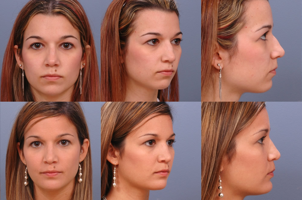 Blepharoplasty