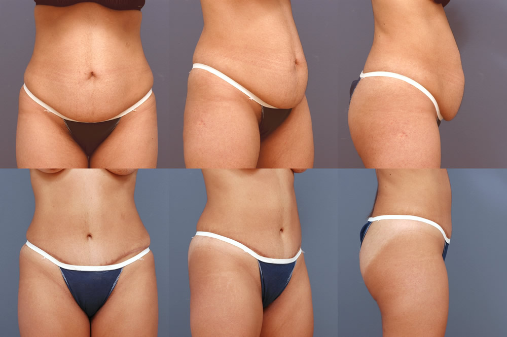 Liposuction Surgeon