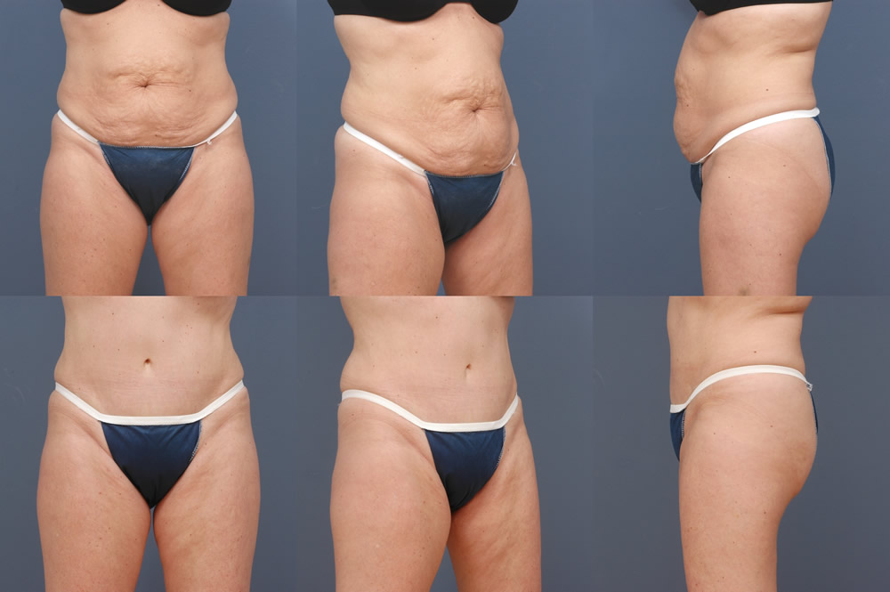 Liposuction Tampa