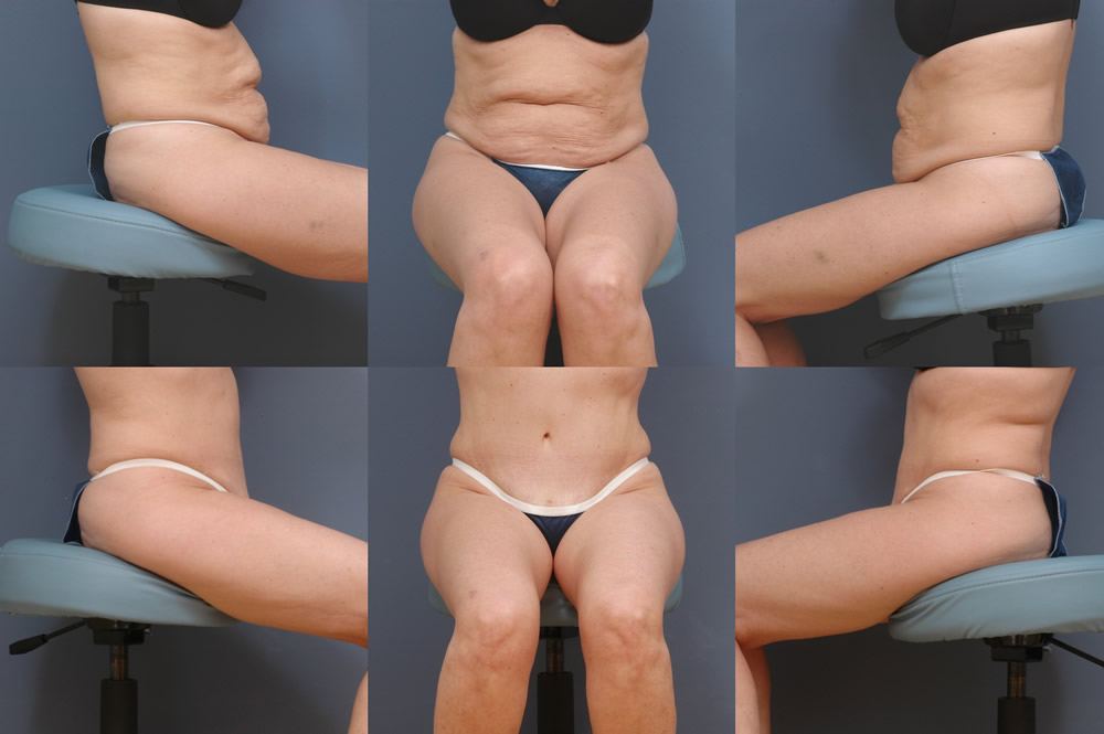 Liposuction Surgery