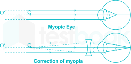 correction of myopia