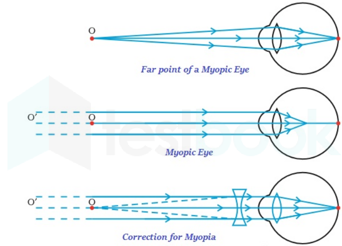 myopia