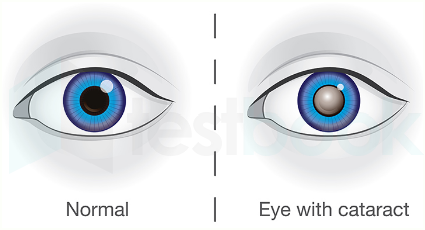 cataract