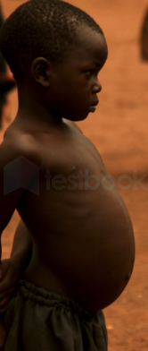 kwashiorkor