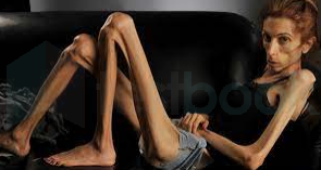 anorexia