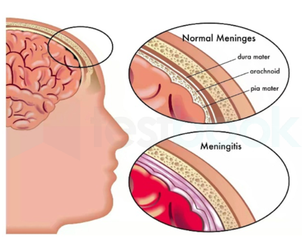 meninigitis