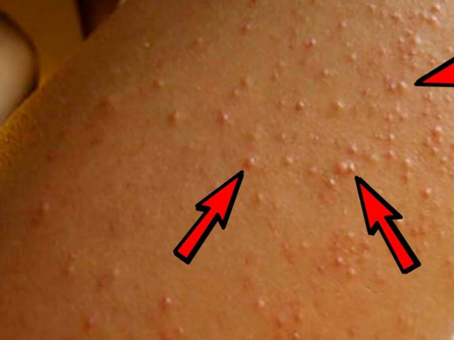 Keratosis Pilaris A Dermatologist Shares Everything You Need To Know About The Chicken Skin