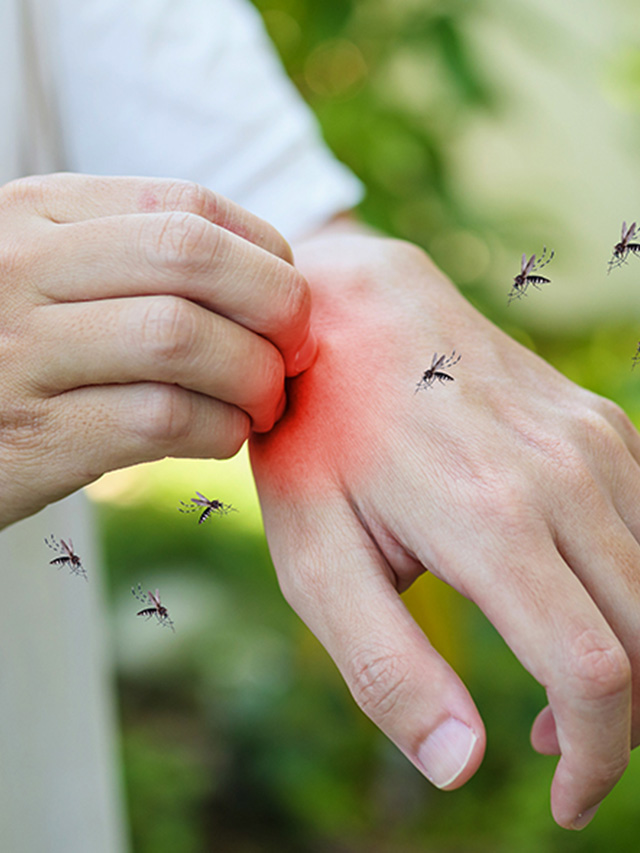 10 Effective Home Remedies & Tips For Mosquito Bites