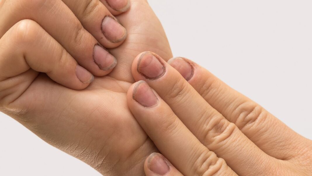 What Causes Hangnails & How Do I Prevent Them From Happening In The First Place?