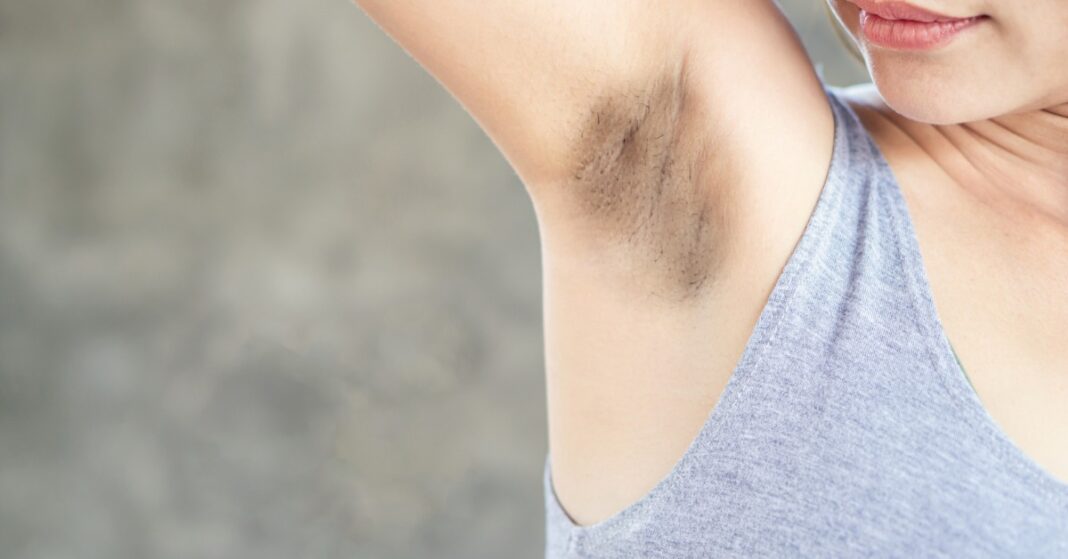 Expert Talk: Places You May Have Dark Patches If You Have PCOS