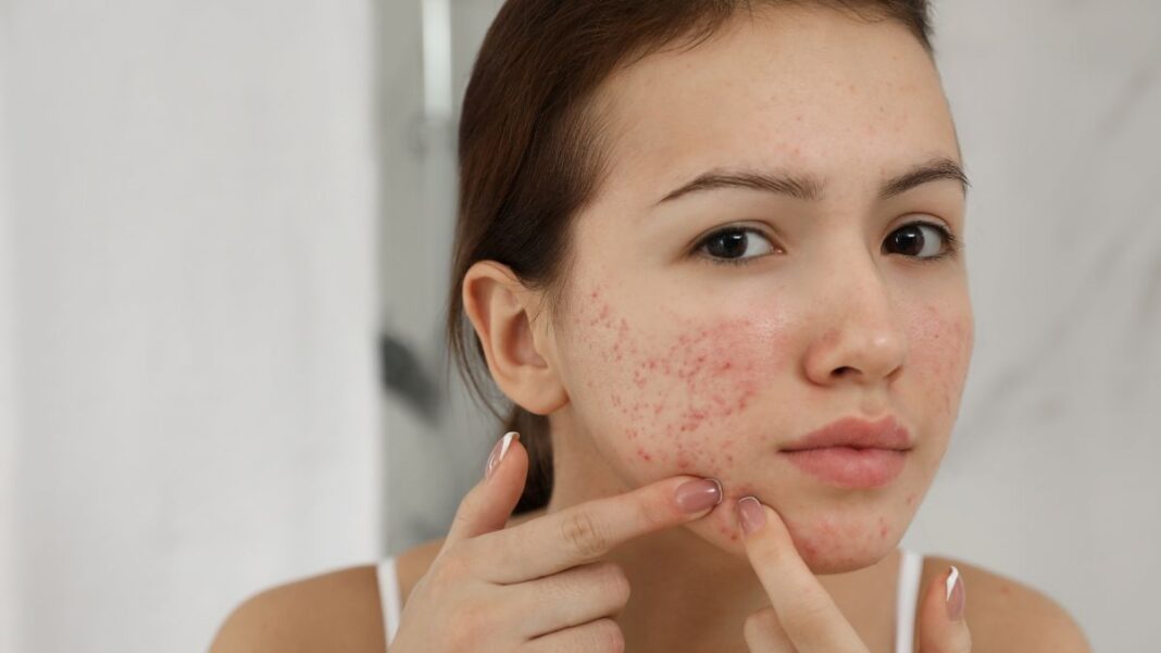 Remember These 6 Basic Skin Care Do’s & Don’ts To Prevent Acne