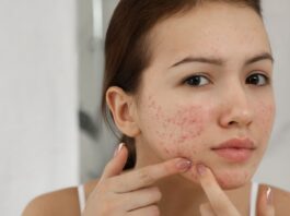 Remember These 6 Basic Skin Care Do’s & Don’ts To Prevent Acne