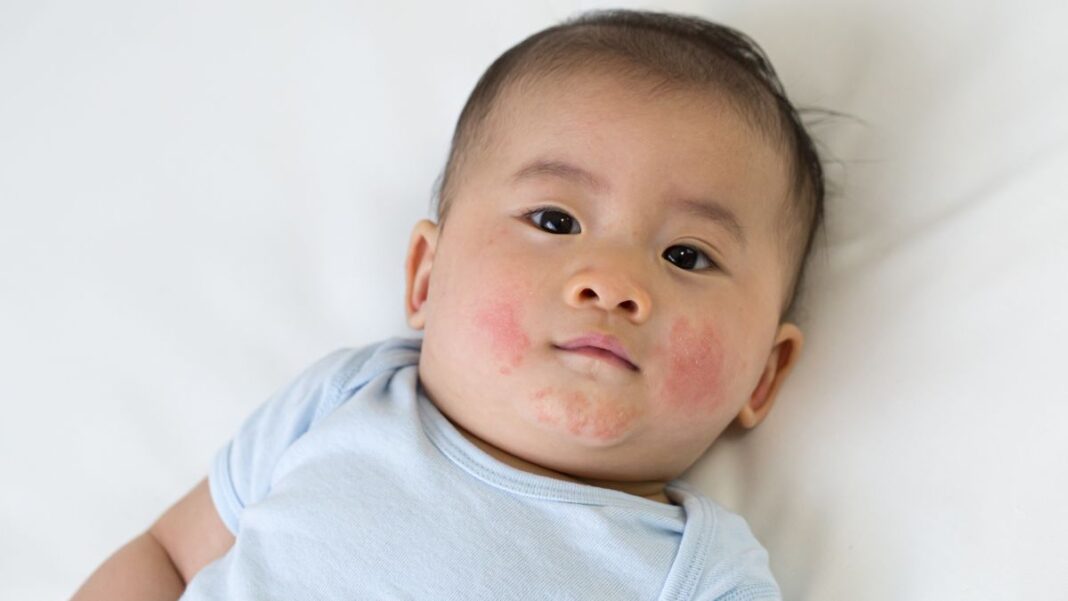 Expert Solutions For Newborn Skin Rashes And Irritations