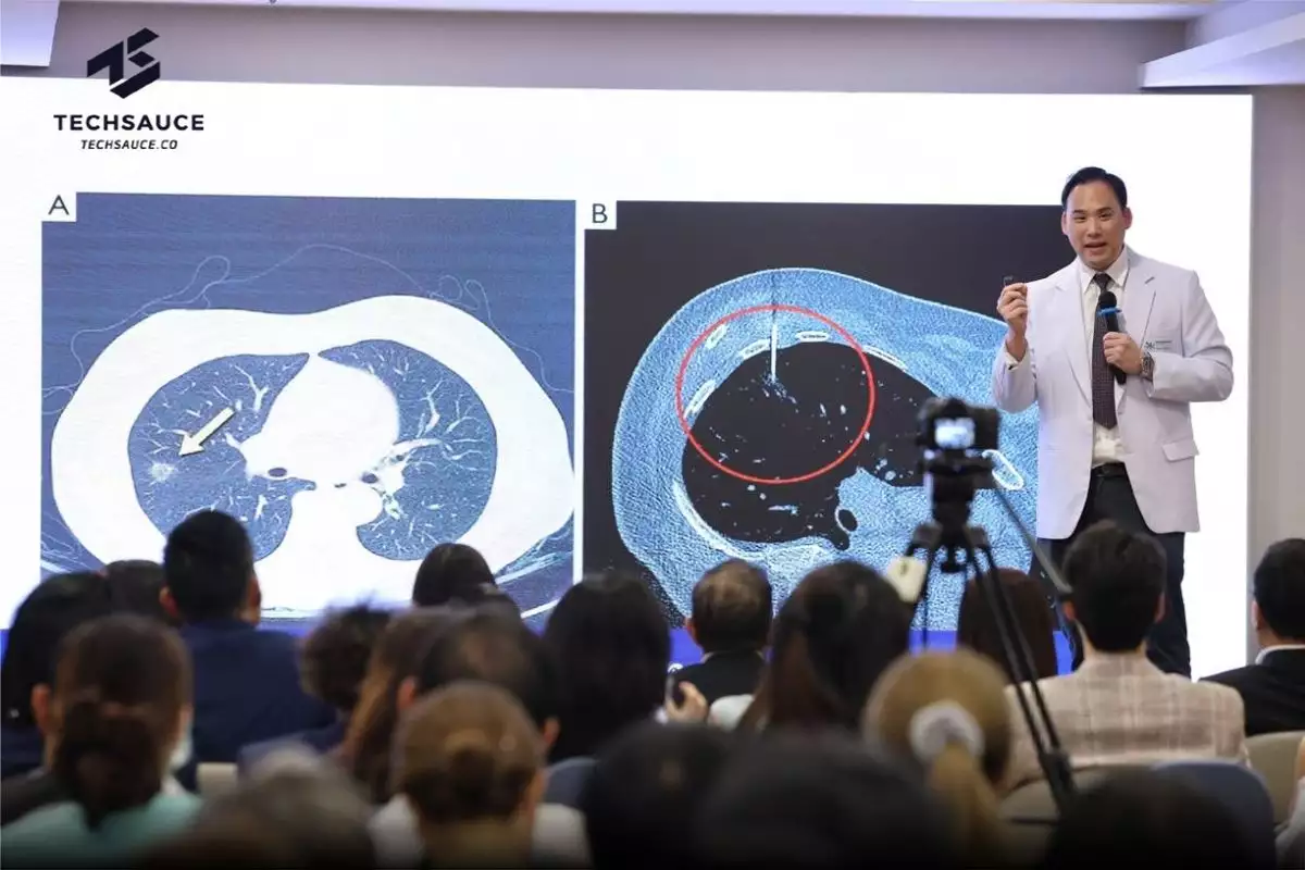 มะเร็งปอด