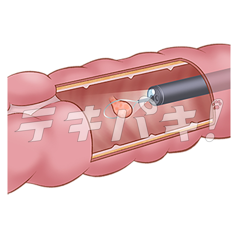 ポリペクトミー_Webサイズ