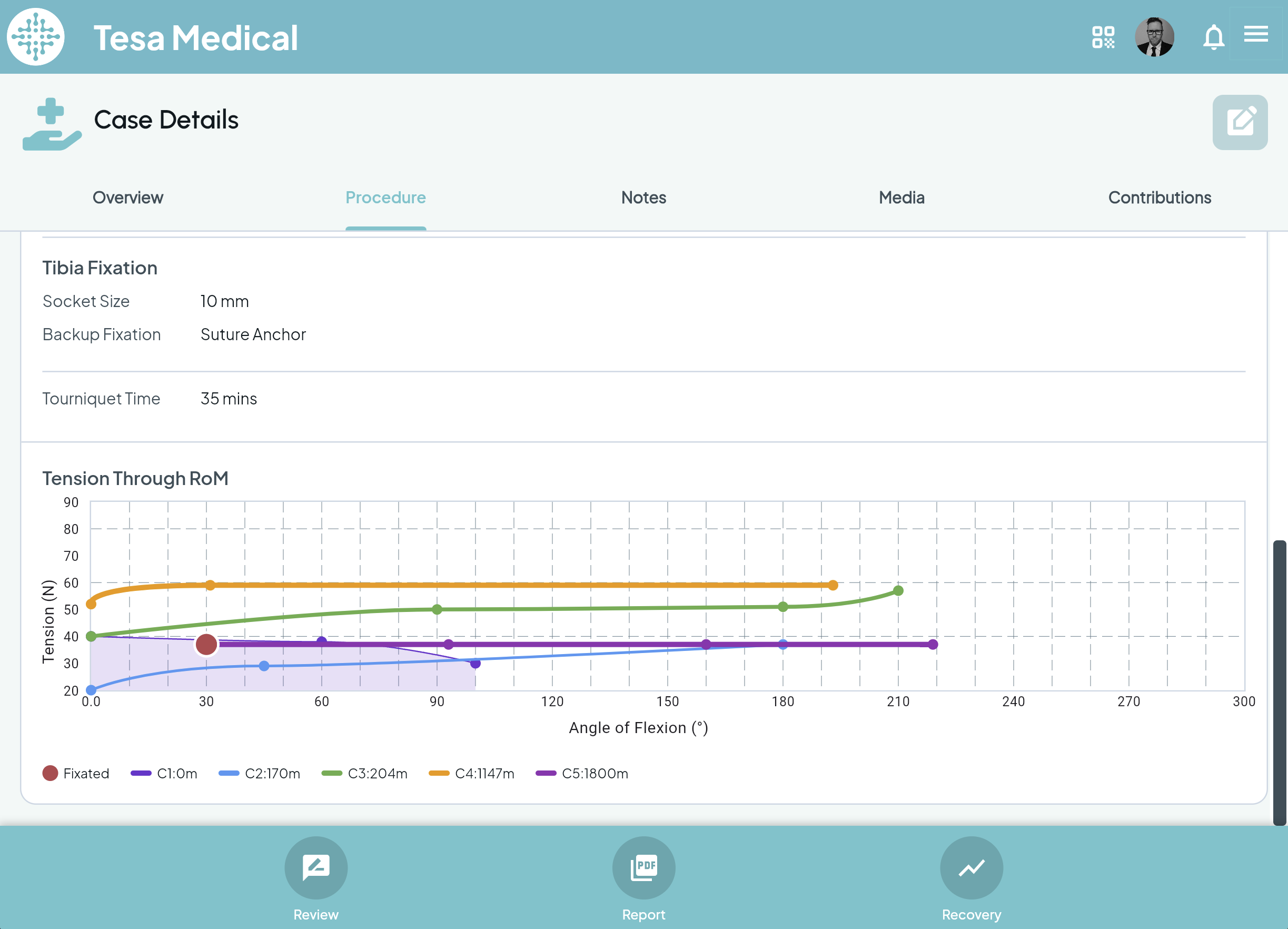 Case details showing procedure data, tibia fixation details, and tension-through-range-of-motion chart