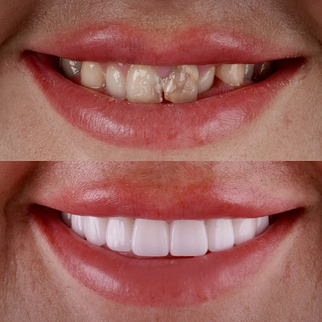 Cirkónium korona előtte-utána