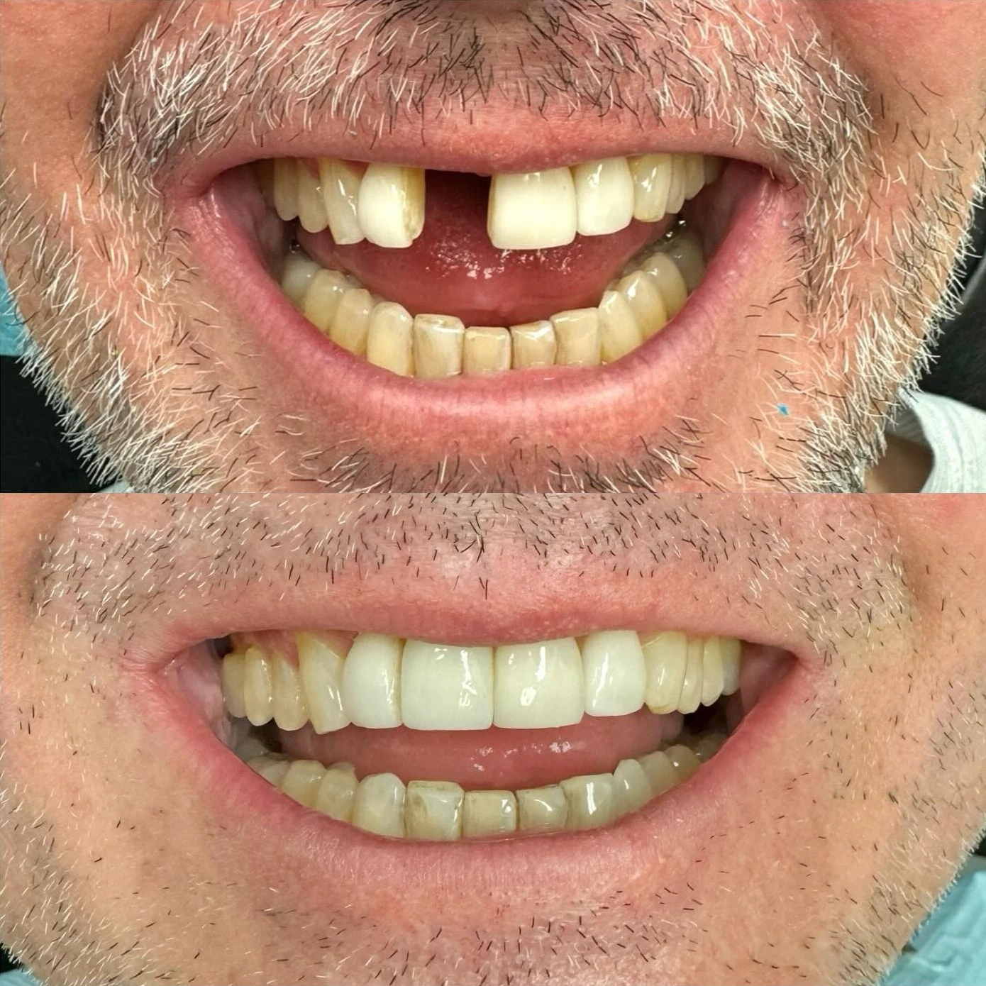 Foghíd előtte-utána