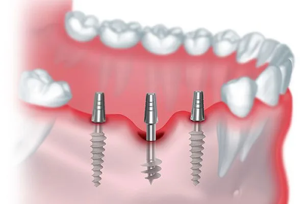 IHDE Implantátumok