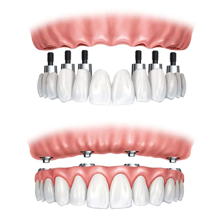Comparison between dentures