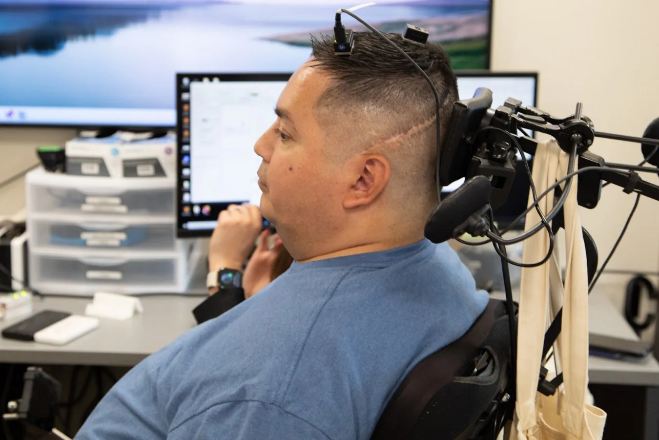 Keith Thomas kept hand feeling for months after his brain stimulation was turned off