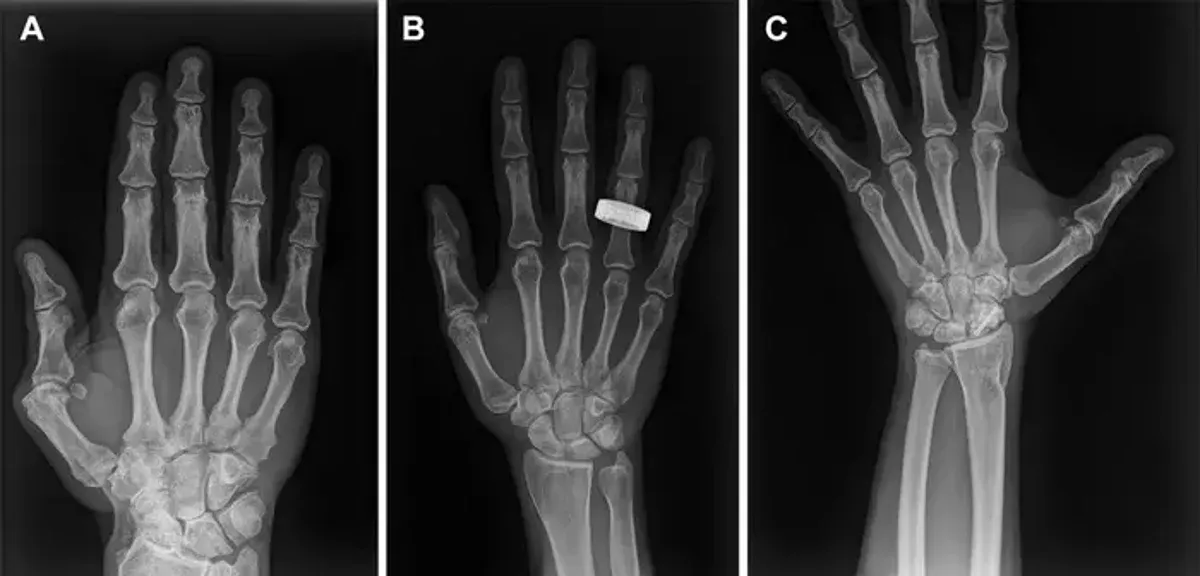 Space x-rays for humans: first in-orbit imaging could change long-duration mission safety