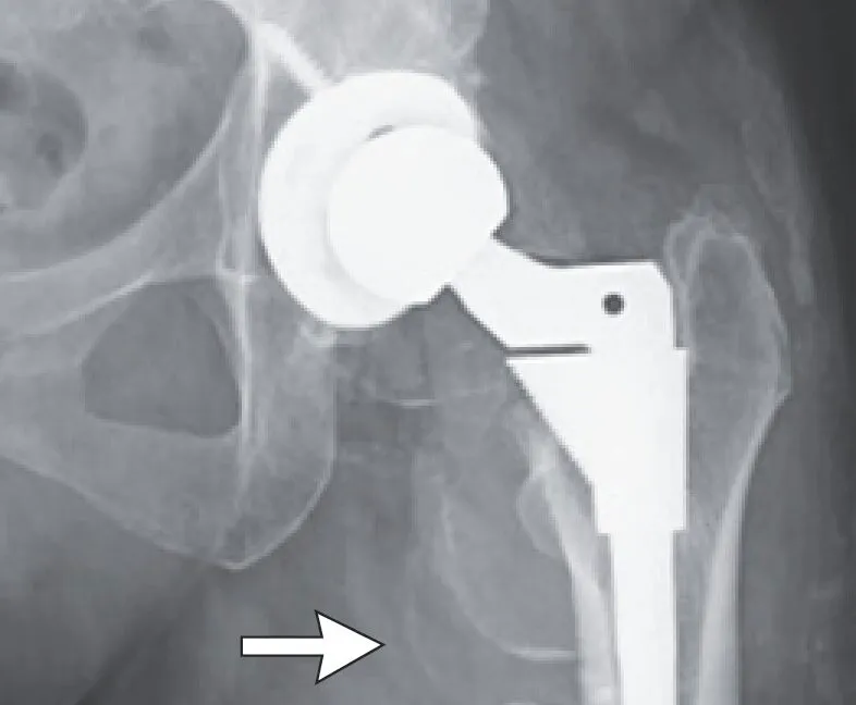 Hip replacement cobalt poisoning scrambled a woman’s nerves after a 19-year failure window