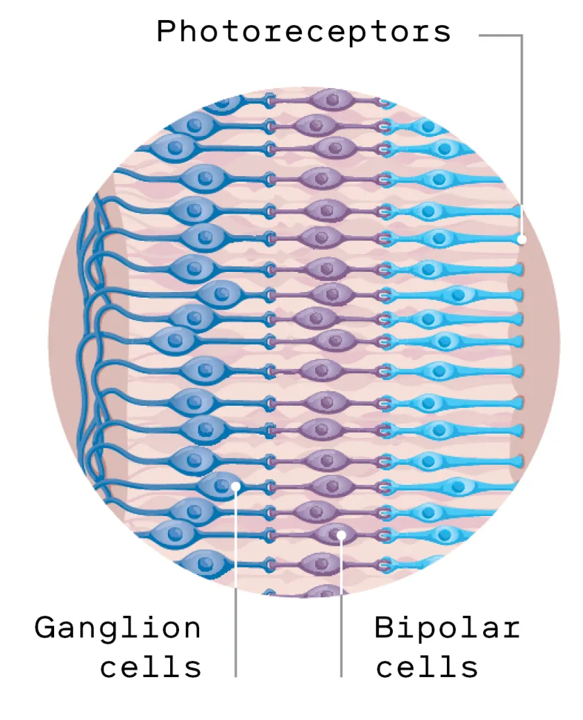 The 378-pixel implant that restores sight in macular degeneration