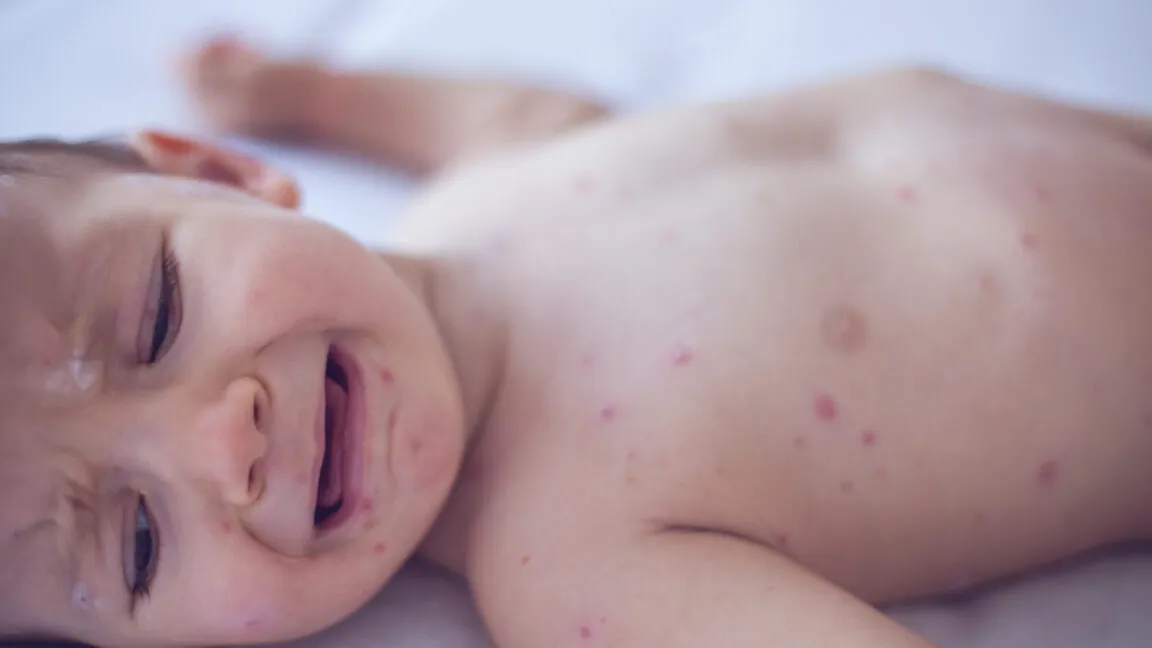 Coroner confirms measles killed 6-week-old as RFK Jr. disputes deaths