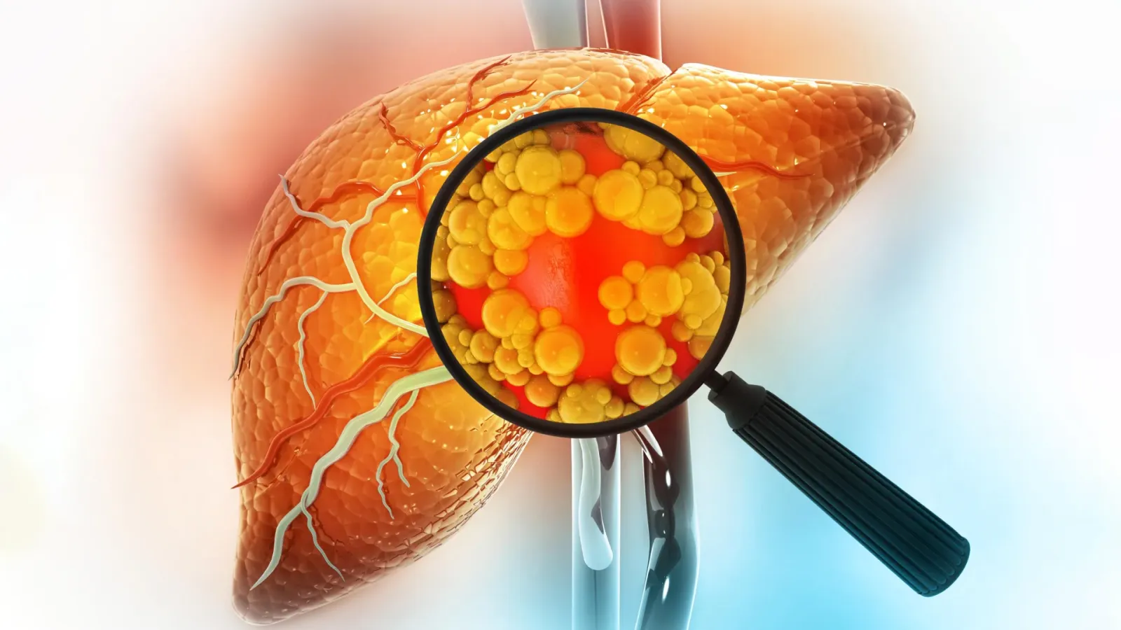 DT-109 reversed severe fatty liver in animals by repairing the gut, scientists report