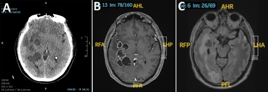 Spanish doctors chased metastatic cancer and found multiple brain lesions caused by worms