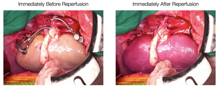Matthew Powell Palm supercools pig kidneys for 72 hours, reversing organ storage limits