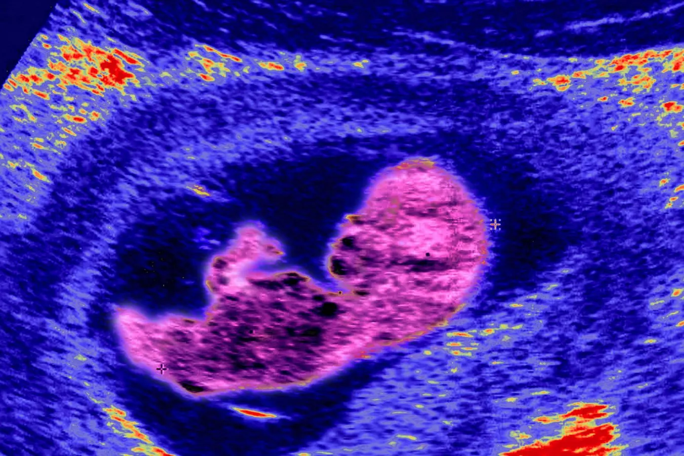Your mother's cells are hiding in your brain for life