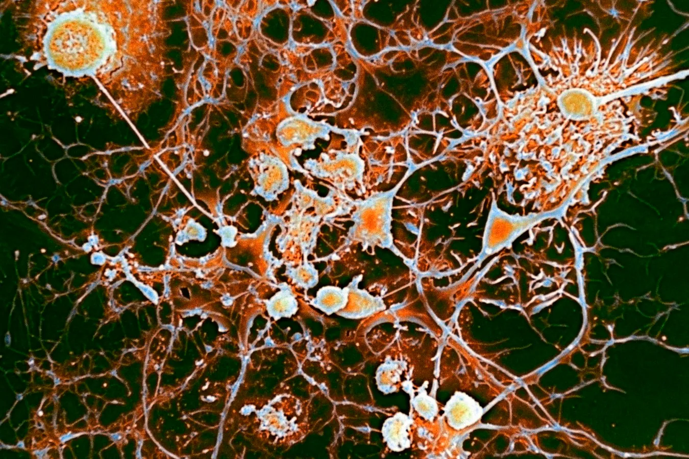 EBV replication drives MS immune attack, hinting antivirals could match B-cell drugs