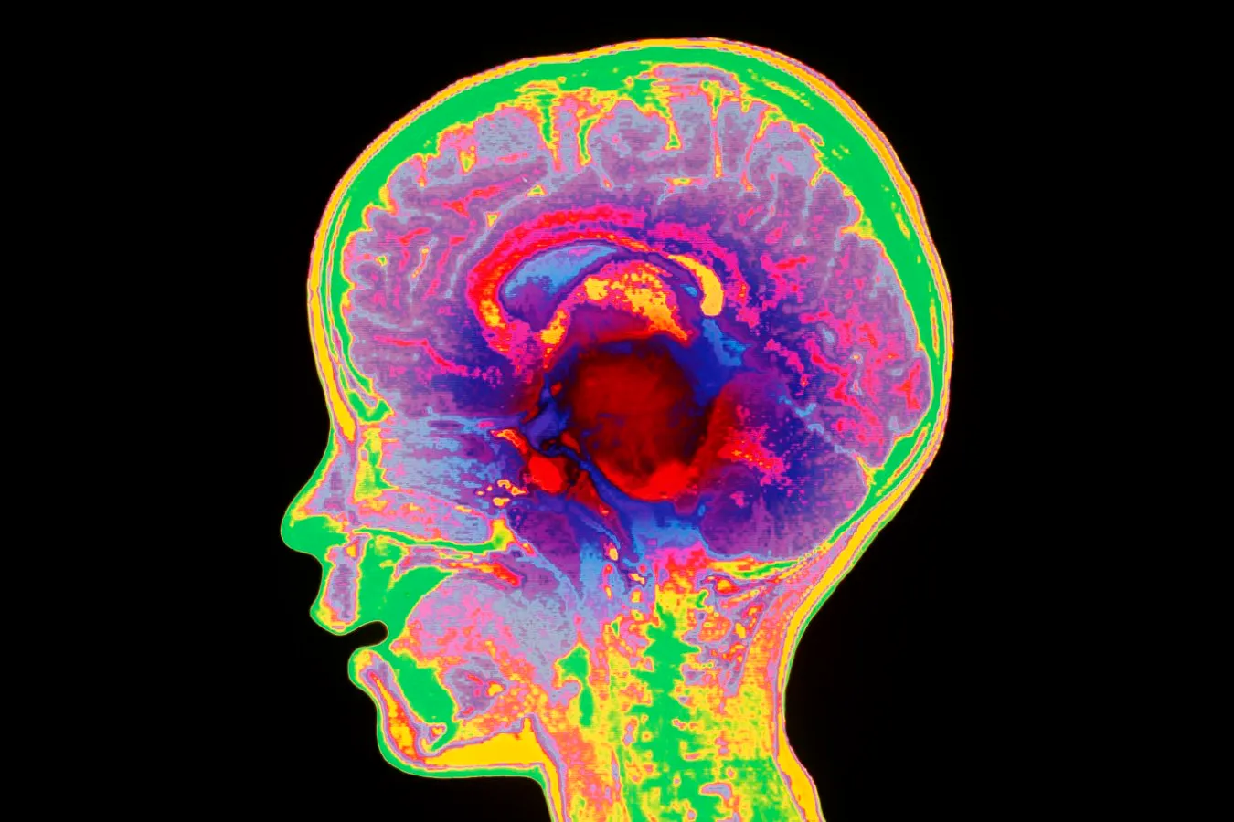 Four children with terminal brain cancer respond to experimental immunotherapy, trials expand