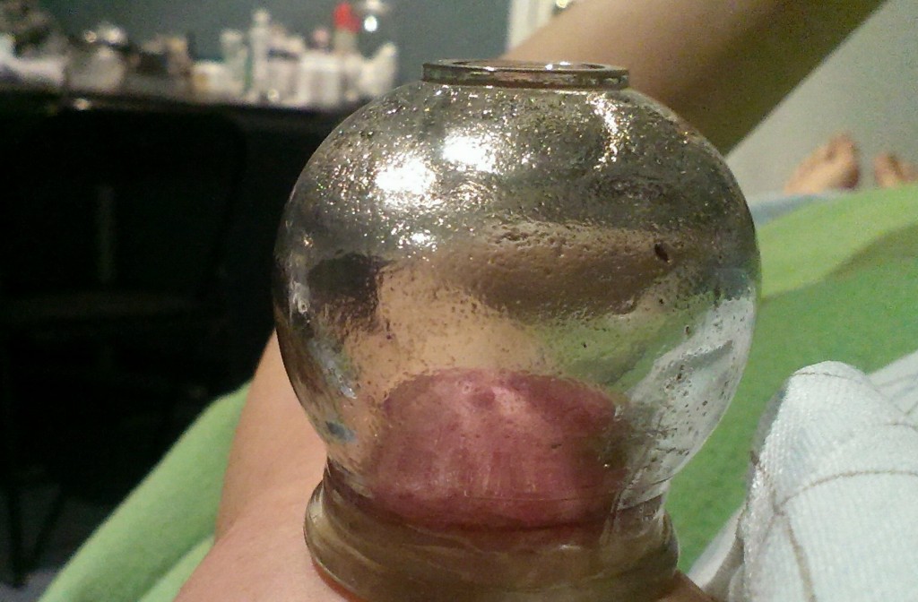 cupping