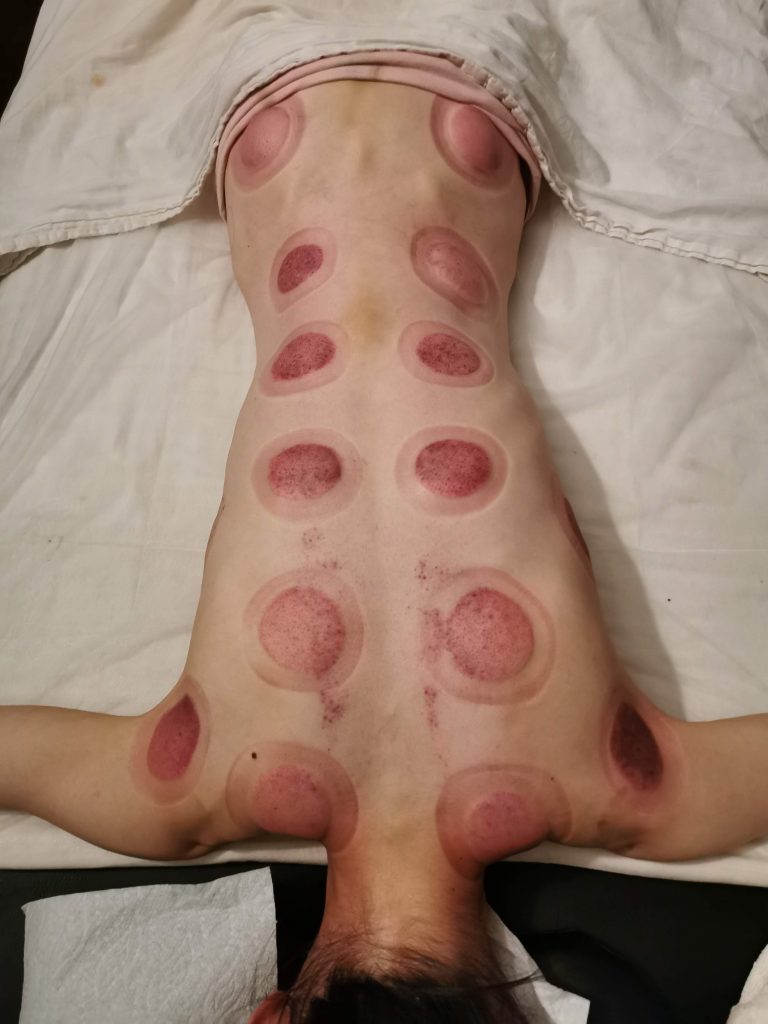 cupping