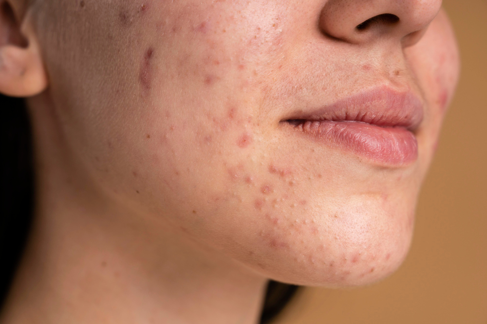 Lumiere Beauty & Spa Acne Treatment | Murray Utah