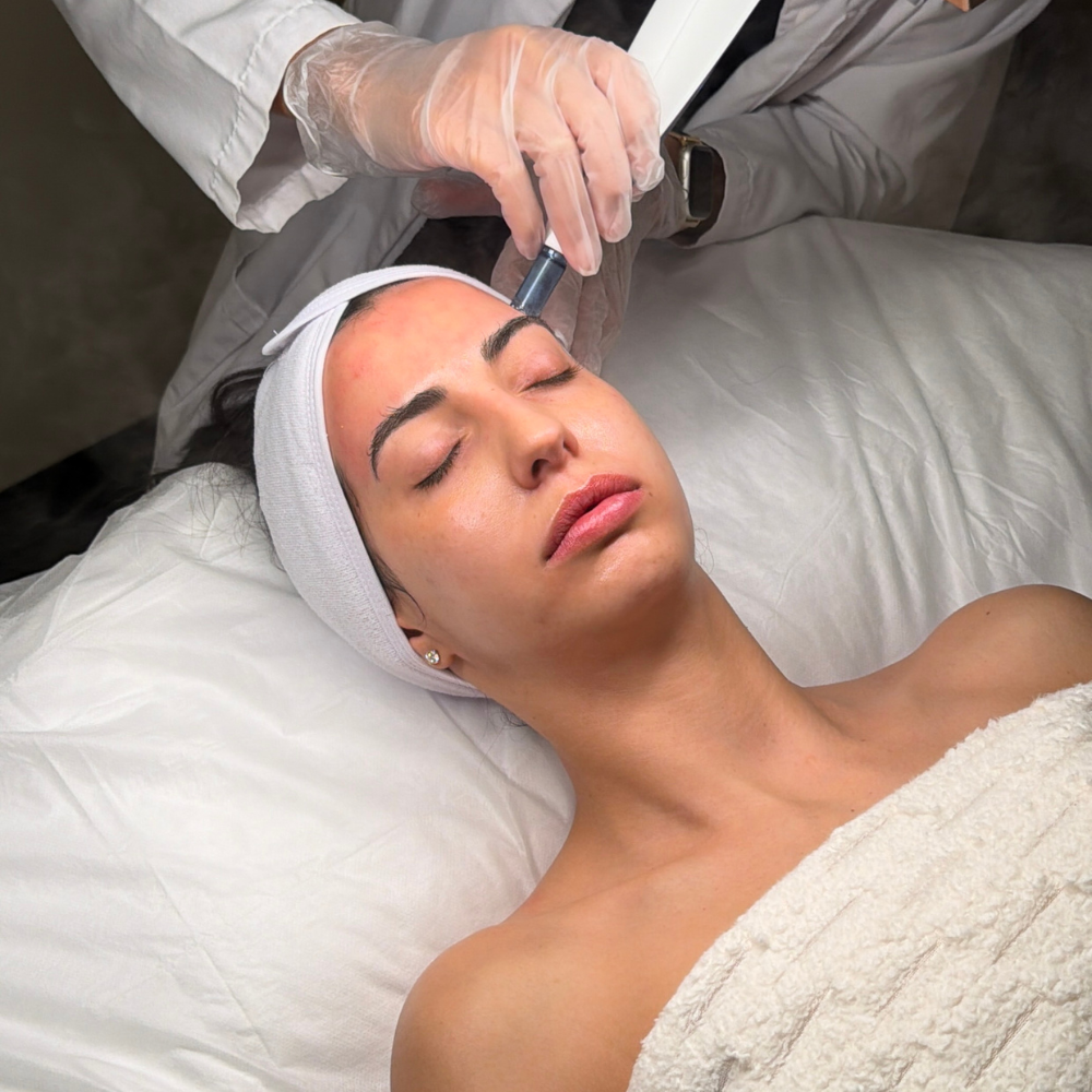 Microneedling