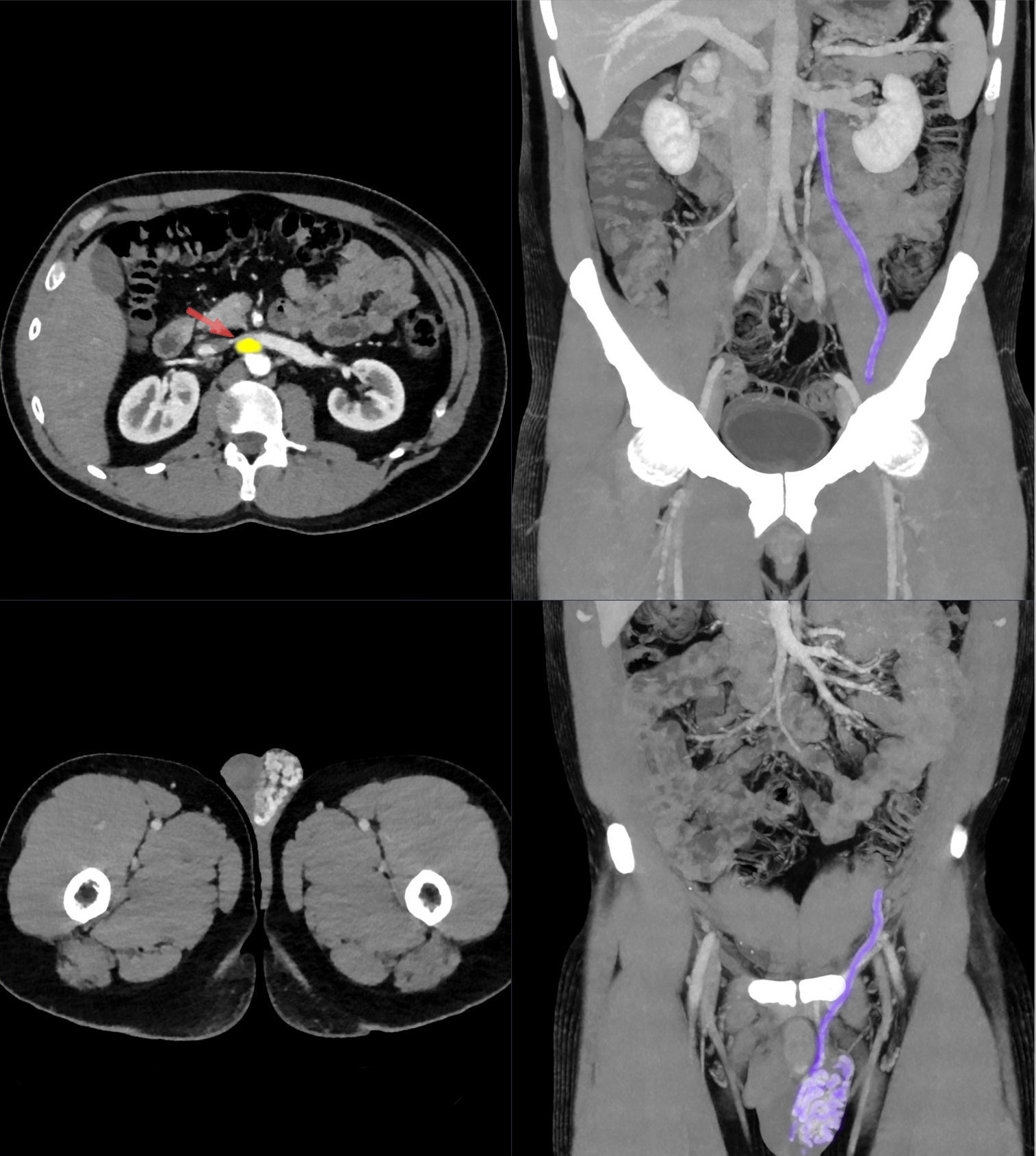 Annotated contrast-enhanced abdominal CT scan in axial and coronal views, with an arrow marking a lymph node between the aorta and the left renal vein.