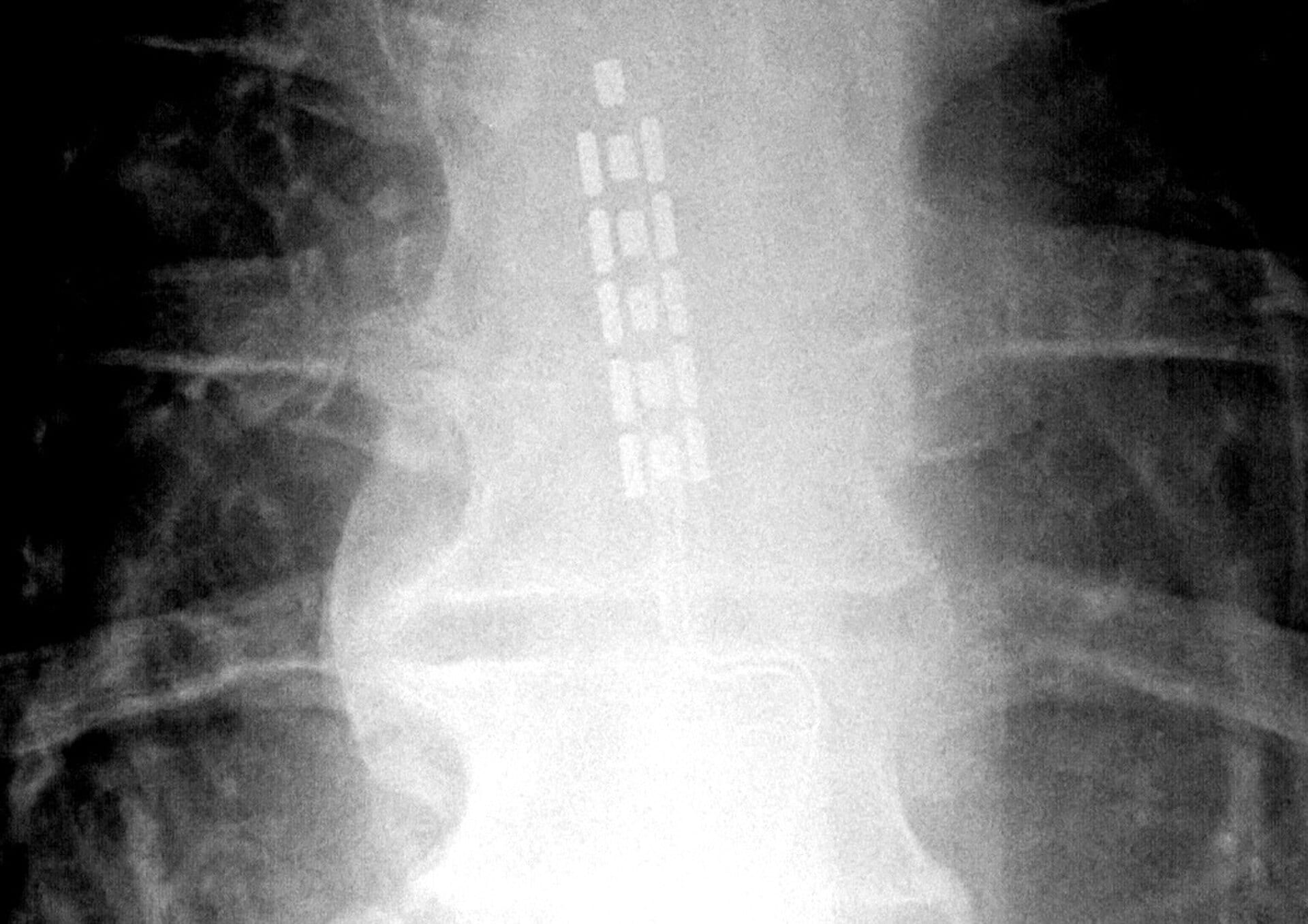 X-ray showing spinal cord stimulator electrode arrays implanted along a patient's spine