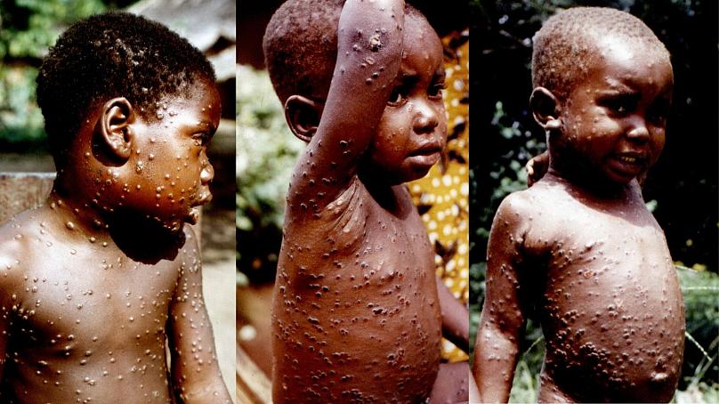 MONKEYPOX: ANOTHER RED ALERT FOR NIGERIA | THISDAYLIVE