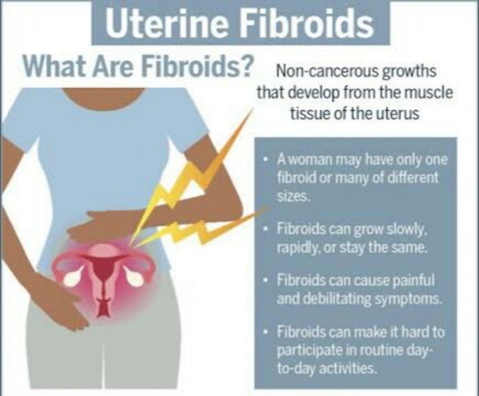 FIBROID AND FERTILITY (PART 1) | THISDAYLIVE