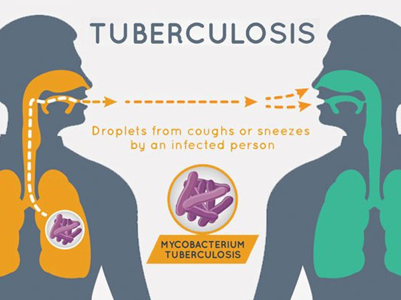 New 51 Cases of Tuberculosis Discovered in Benue | THISDAYLIVE