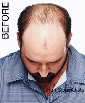 American Hairlines Non-Surgical Hair Replacement - Before