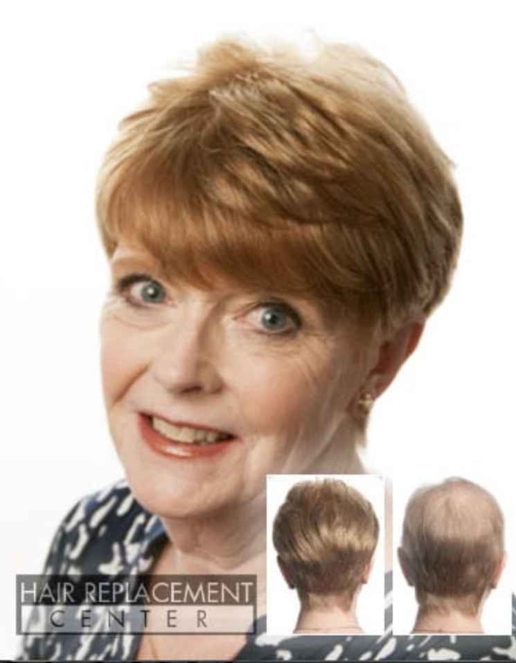 Women’s Hair Replacement