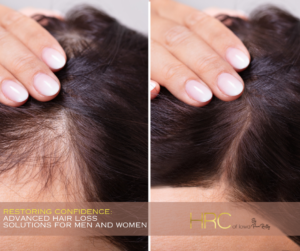 Restoring Confidence: Advanced Hair Loss Solutions for Men and Women