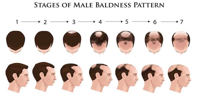 Male Pattern Baldness Illustration